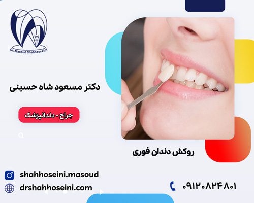 روکش دندان فوری