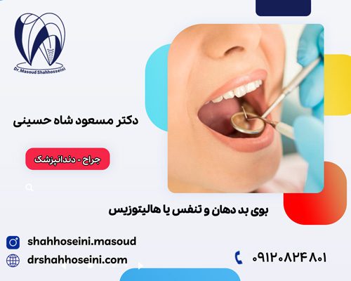 بوی بد دهان یا هالیتوزیس
