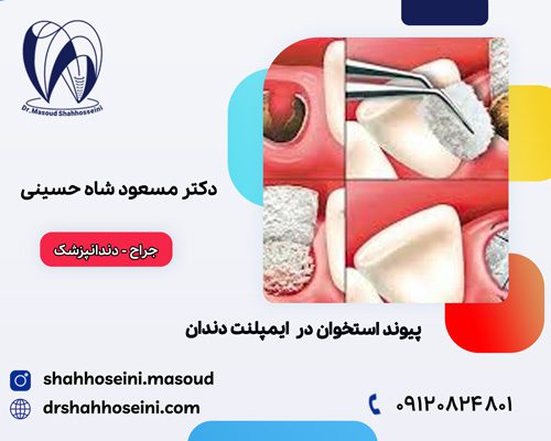 پیوند استخوان در ایمپلنت دندان