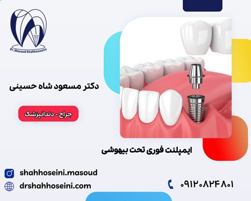 ایمپلنت فوری تحت بیهوشی