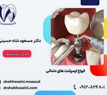 انواع ایمپلنت های دندانی