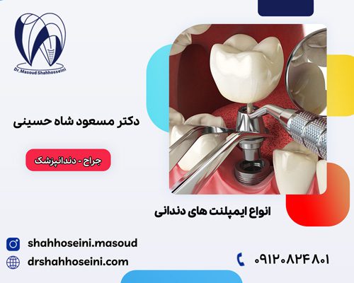 انواع ایمپلنت های دندانی