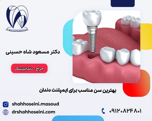 بهترین سن مناسب برای ایمپلنت دندان