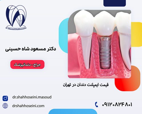 قیمت ایمپلنت دندان در تهران