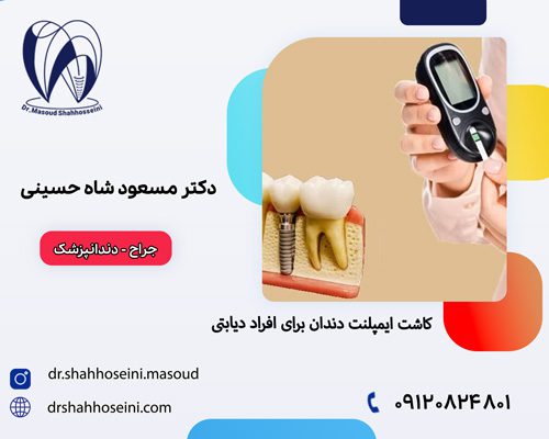 کاشت ایمپلنت دندان برای افزاد دیابتی