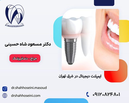 ایمپلنت دیجیتال در شرق تهران