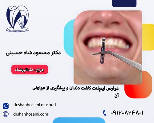 عوارض کاشت ایمپلنت دندان