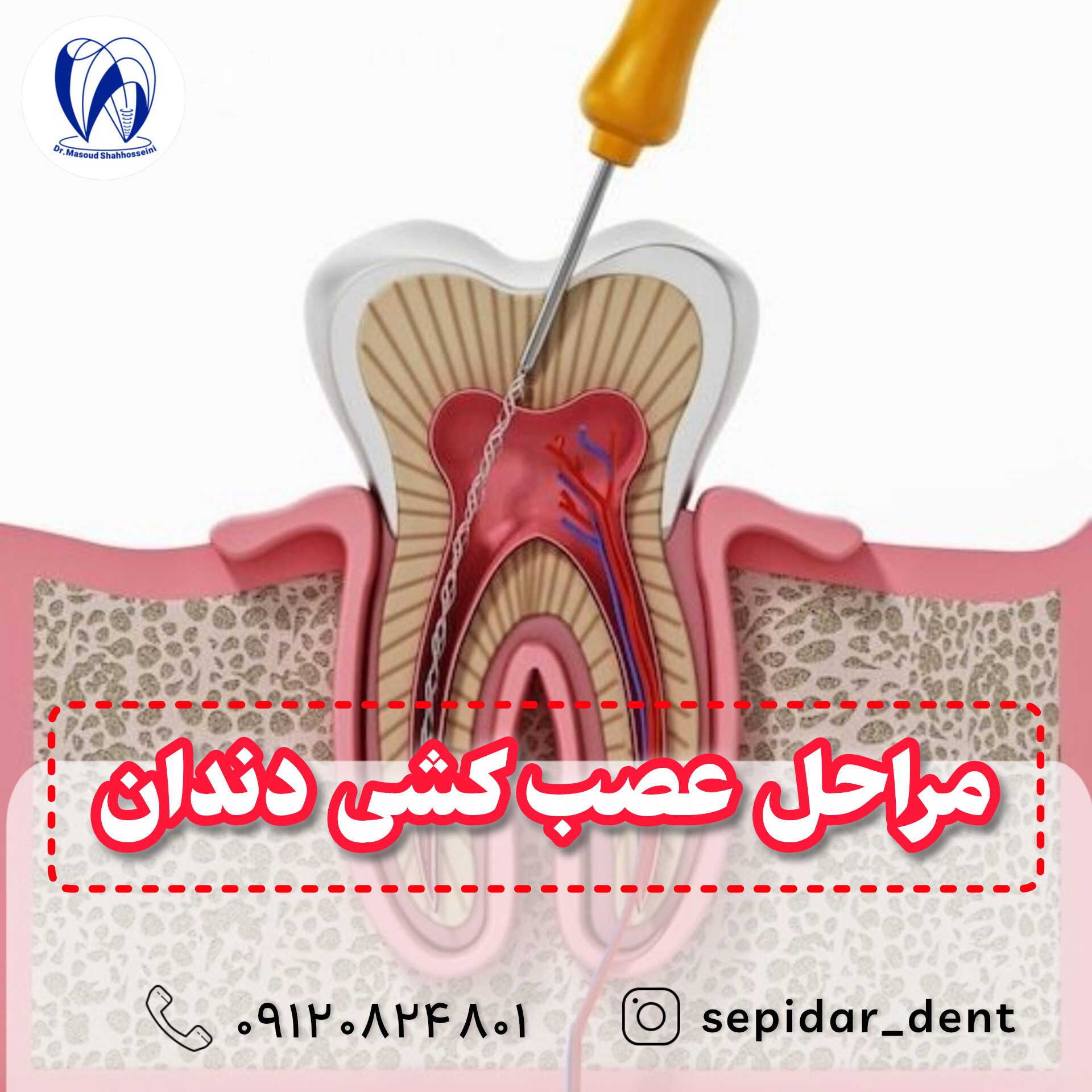 مراحل عصب کشی دندان