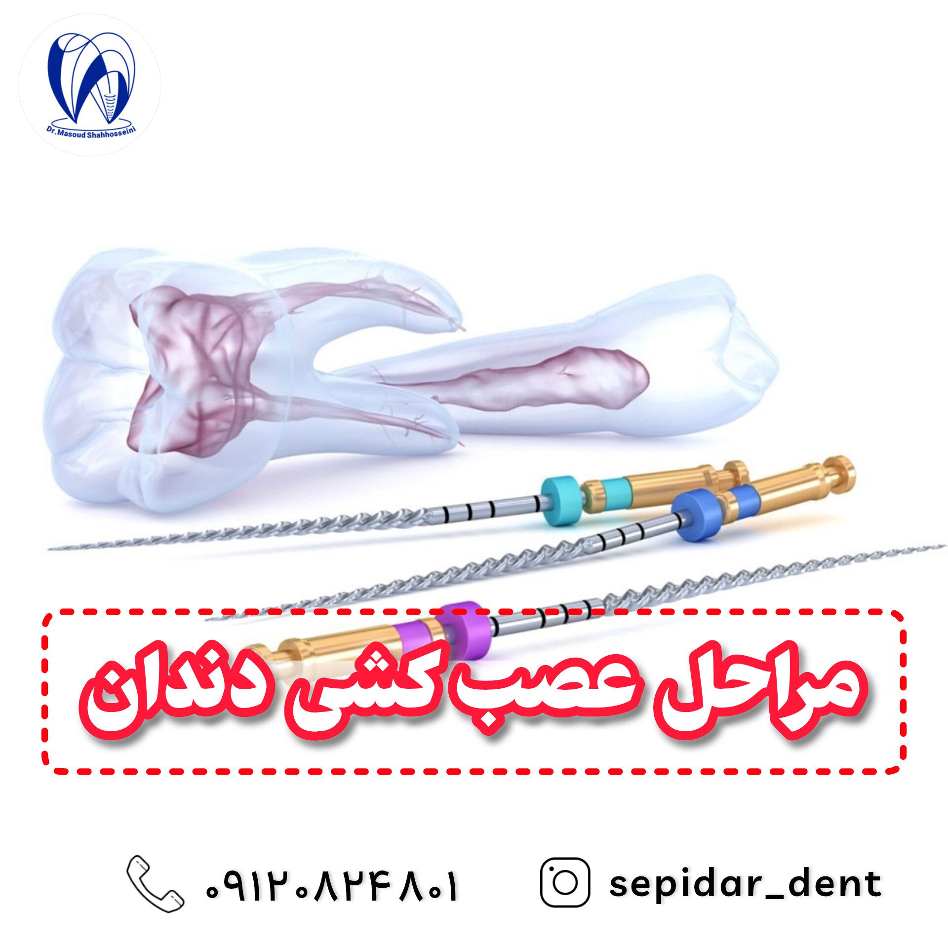 عصب کشی دیجیتال