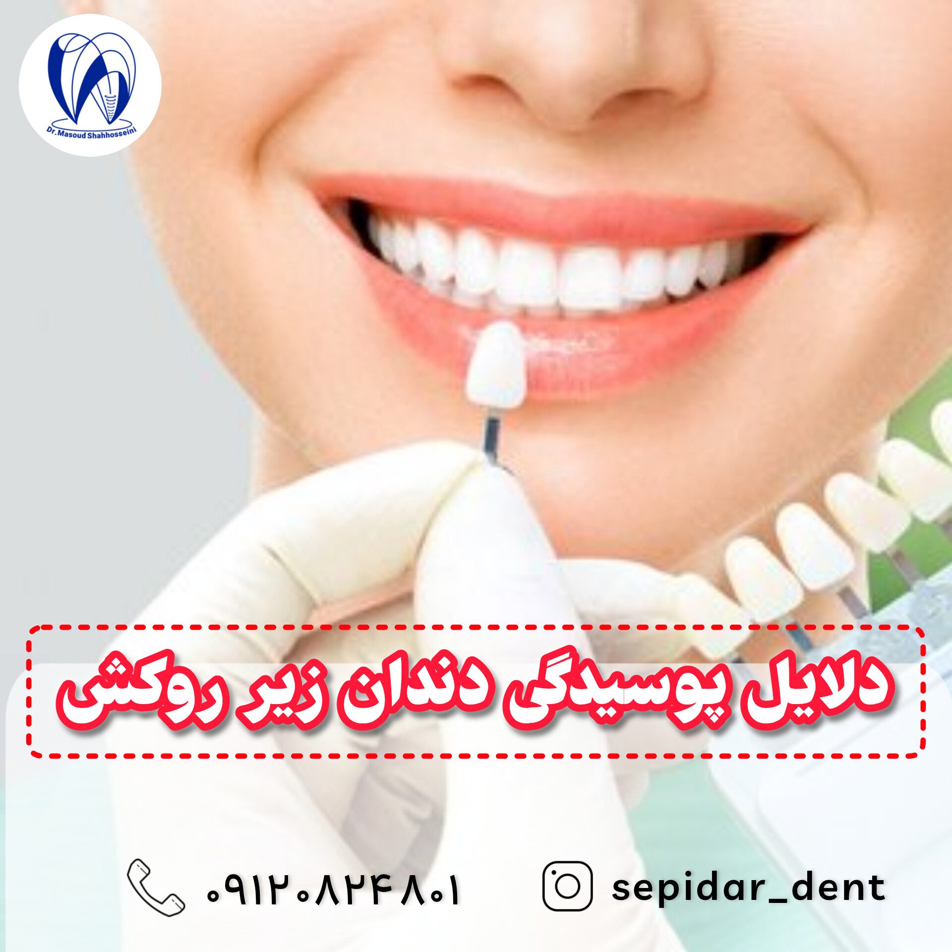 دلایل پوسیدگی دندان زیر روکش