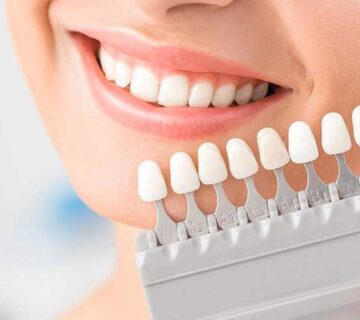 لمینیت سرامیکی بهتره یا کامپوزیتی؟