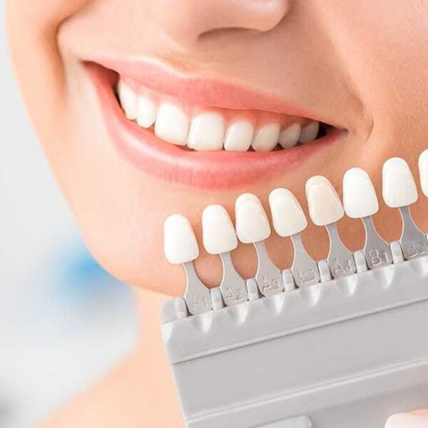 لمینیت سرامیکی بهتره یا کامپوزیتی؟