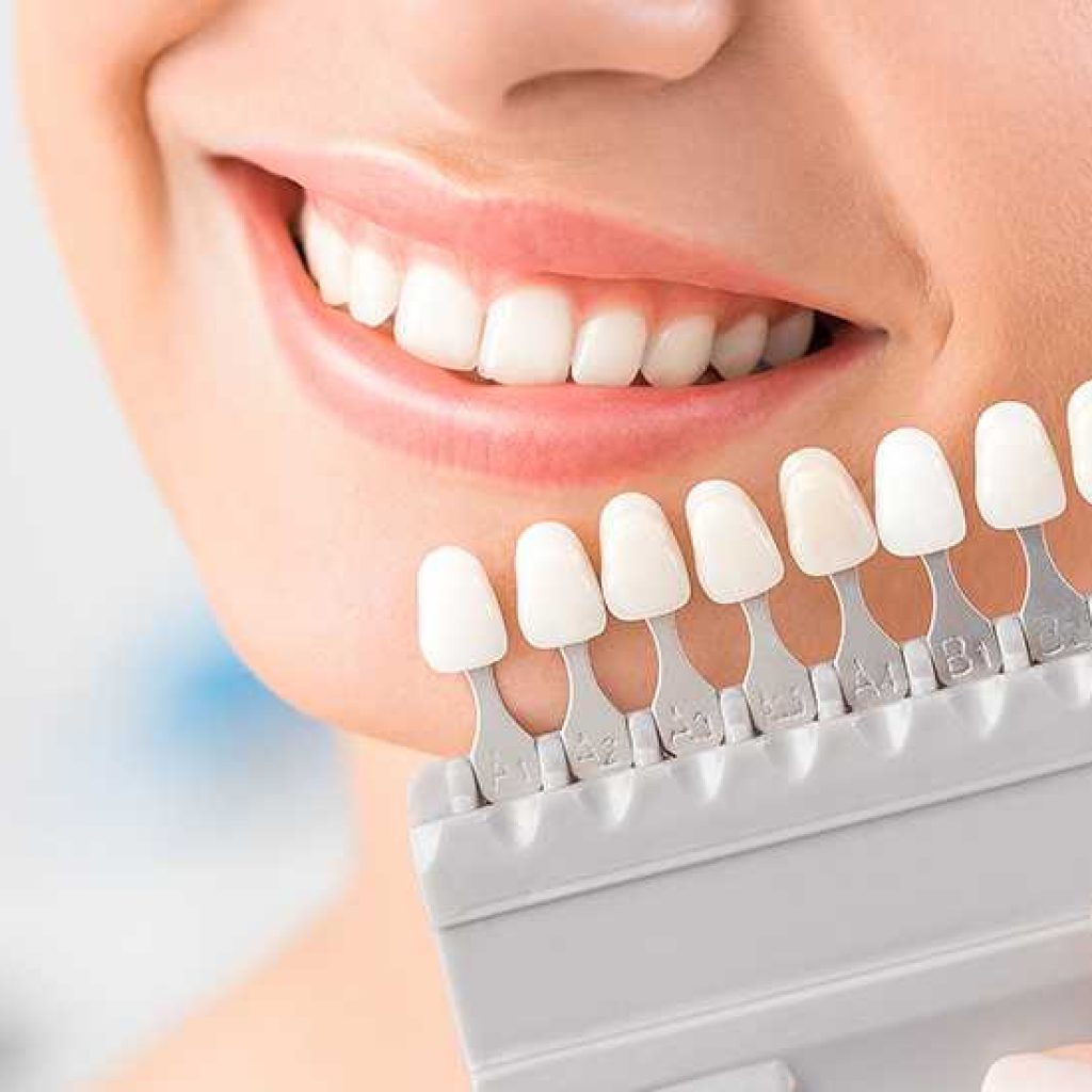 لمینیت سرامیکی بهتره یا کامپوزیتی؟