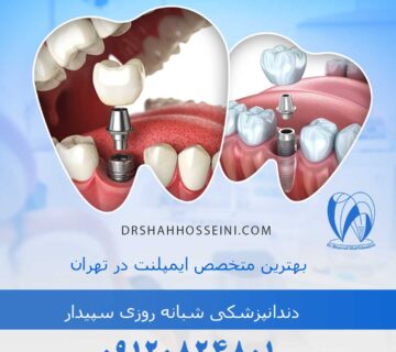 بهترین متخصص ایمپلنت در تهران