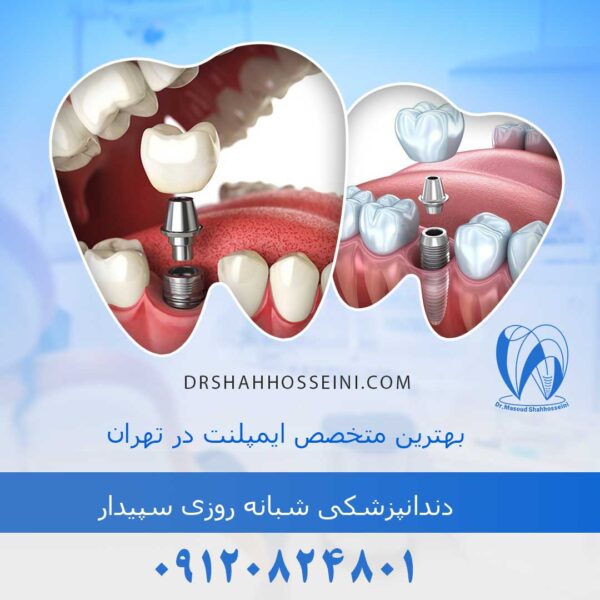 بهترین متخصص ایمپلنت در تهران