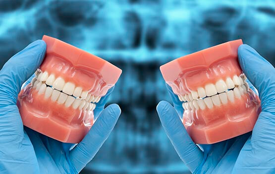 هدف از قالبگیری دندان مصنوعی چیست؟