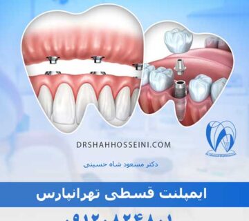 ایمپلنت قسطی تهرانپارس