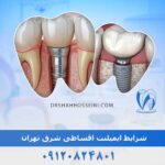 شرایط ایمپلنت اقساطی شرق تهران