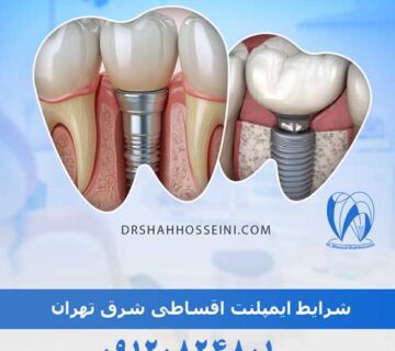 شرایط ایمپلنت اقساطی شرق تهران